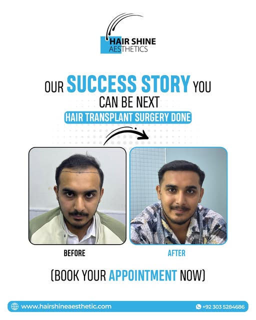 𝐘𝐨𝐮𝐫 𝐍𝐞𝐰 𝐇𝐚𝐢𝐫 𝐒𝐭𝐨𝐫𝐲 𝐒𝐭𝐚𝐫𝐭𝐬 𝐇𝐞𝐫𝐞!
#HairTransplant #HairShineAesthetics #Hai