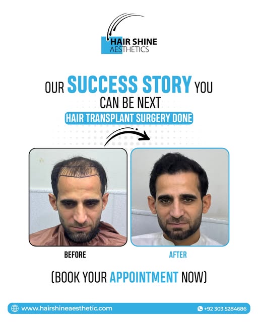 𝐘𝐨𝐮𝐫 𝐍𝐞𝐰 𝐇𝐚𝐢𝐫 𝐒𝐭𝐨𝐫𝐲 𝐒𝐭𝐚𝐫𝐭𝐬 𝐇𝐞𝐫𝐞!
#HairTransplant #HairShineAesthetics #Hai