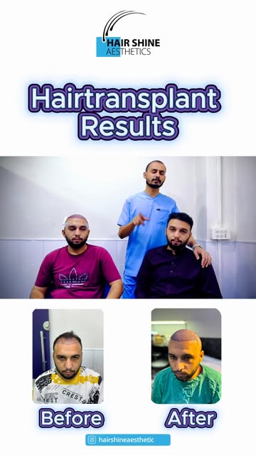 𝐂𝐥𝐢𝐞𝐧𝐭 𝐫𝐞𝐯𝐢𝐞𝐰 𝐚𝐟𝐭𝐞𝐫 𝐡𝐚𝐢𝐫 𝐭𝐫𝐚𝐧𝐬𝐩𝐥𝐚𝐧𝐭!
#HairShineAesthetics #HairTransp