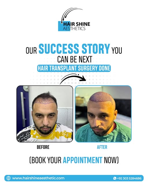 𝐘𝐨𝐮𝐫 𝐍𝐞𝐰 𝐇𝐚𝐢𝐫 𝐒𝐭𝐨𝐫𝐲 𝐒𝐭𝐚𝐫𝐭𝐬 𝐇𝐞𝐫𝐞!
#HairTransplant #HairShineAesthetics #Hai