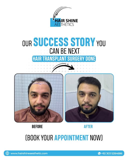 𝐘𝐨𝐮𝐫 𝐍𝐞𝐰 𝐇𝐚𝐢𝐫 𝐒𝐭𝐨𝐫𝐲 𝐒𝐭𝐚𝐫𝐭𝐬 𝐇𝐞𝐫𝐞!
#HairTransplant #HairShineAesthetics #Hai