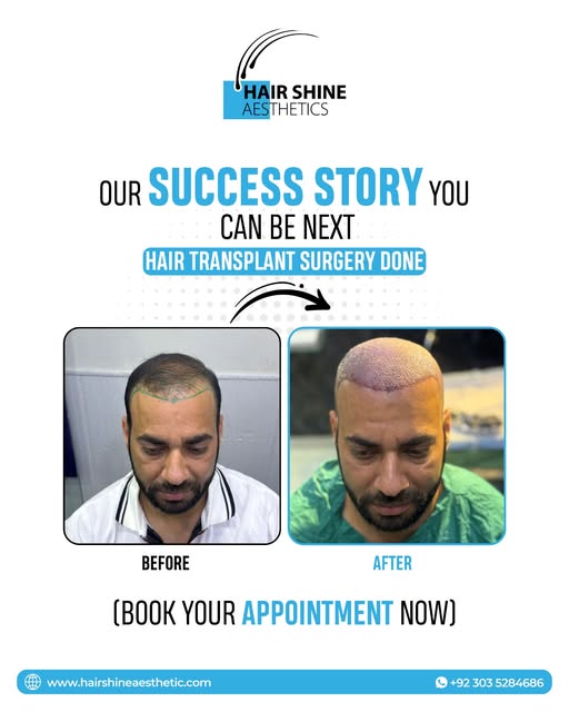 𝐘𝐨𝐮𝐫 𝐍𝐞𝐰 𝐇𝐚𝐢𝐫 𝐒𝐭𝐨𝐫𝐲 𝐒𝐭𝐚𝐫𝐭𝐬 𝐇𝐞𝐫𝐞!
#HairTransplant #HairShineAesthetics #Hai