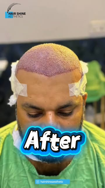 𝐘𝐨𝐮𝐫 𝐇𝐚𝐢𝐫 𝐓𝐫𝐚𝐧𝐬𝐟𝐨𝐫𝐦𝐚𝐭𝐢𝐨𝐧 𝐂𝐨𝐮𝐥𝐝 𝐁𝐞 𝐍𝐞𝐱𝐭!
At Hair Shine Aesthetics, w