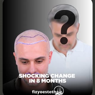Victory at the end of a patient wait! 🏆✨

After a hair transplant, the hair reveals itself a little