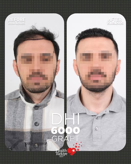 Hair transplantation is not only for full hair loss, but also yields great results for localized thi
