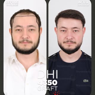 Hair transplantation is a process in which the results gradually settle over time, with a more natur