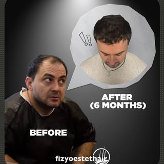 Even in just 6 months, you can see a remarkable difference ✨

Every hair transplant is a journey tha