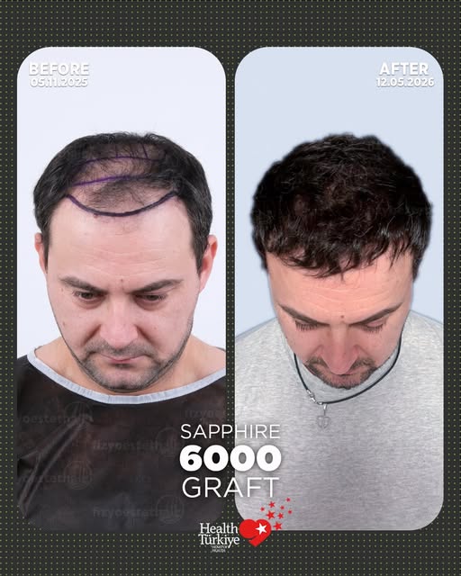 Swipe to see our patient’s amazing 6-month transformation! 

Natural hairline, maximum density, and 