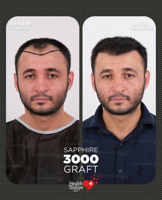 Patient’s transformation photos at 10 months post-hair transplant. The results speak for themselves—