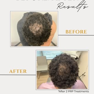 ⭐ Before & After 2 Hair PRP Sessions ⭐

These are early results for hair PRP and we're seeing such g