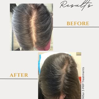 A fuller part line after just three PRP treatments! Results like these are why we love what we do. ✨