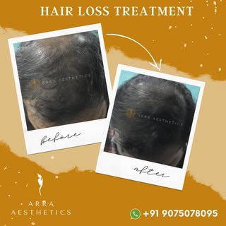 "Fuller Hair! 🌿 Our non-surgical hair loss treatments offer visible results without a hair transpla