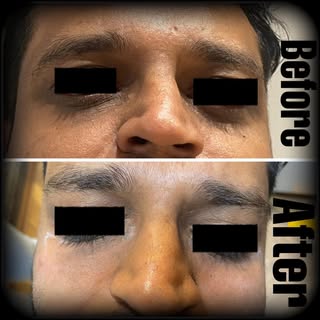 Transform your tried under eye with fillers! 

Dr Rutva ✨Undereyes enhancement ✨ 
 Get rid of the ti