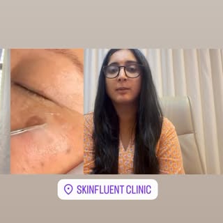 #dermaawareness #korean treatment