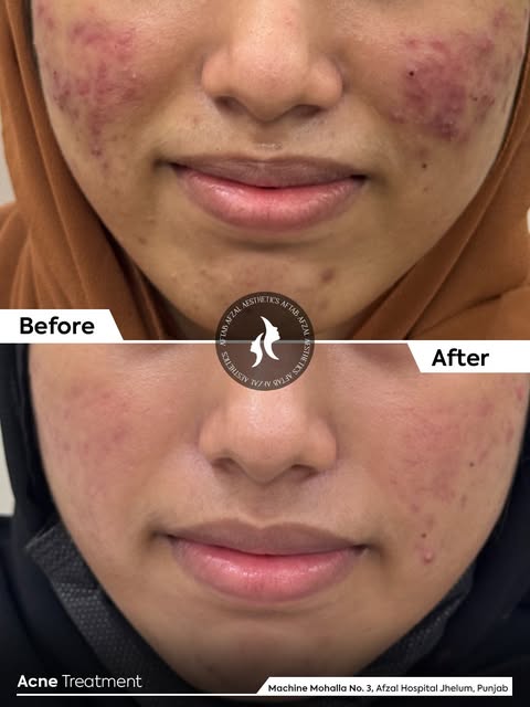 Acne Treatment Results

Clearer, healthier-looking skin starts with the right treatment and consiste