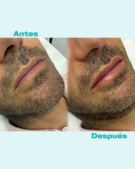 Labios naturales, también para hombres.

Un tratamiento con ácido hialurónico no siempre significa d
