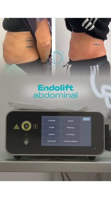 ¿Grasa localizada y flacidez en el abdomen? 

Hoy hablamos de Endolift abdominal, un tratamiento mín