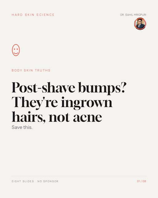 Post-shave bumps? Those are ingrown hairs, not acne.

Curved hair curls back into the skin after a c