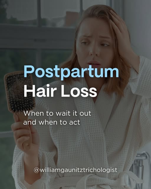 Postpartum hair loss affects most new mothers and tends to resolve on its own. 

But not always. 

S