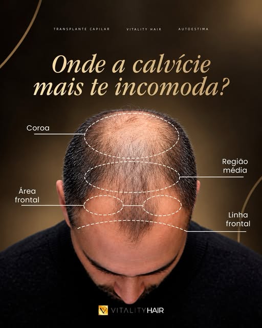 Onde a sua calvície mais te incomoda? 👀

Nas entradas? Na linha frontal? No topo? Ou na coroa?

A q