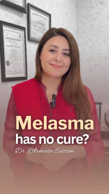 Melasma and pigmentation is considered a chronic, manageable condition rather than a one-time "curab