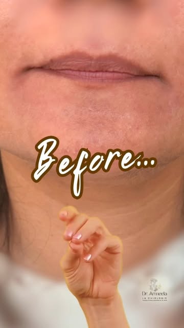 Real results. Natural lips. 💋

Beautiful lip filler doesn't come from a syringe alone. It comes fro