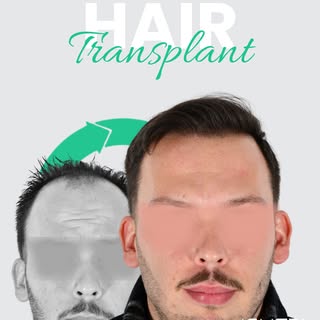 5071 Grafts – 1-Year
The appearance achieved after hair transplantation shows the impact of detailed