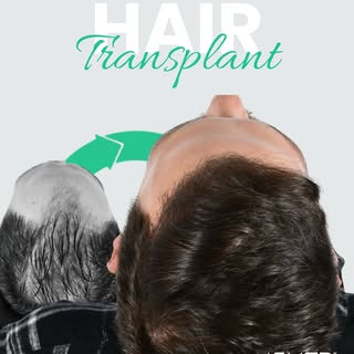 5071 Grafts – 1-Year
A successful hair transplant is not only about adding hair, but also about crea