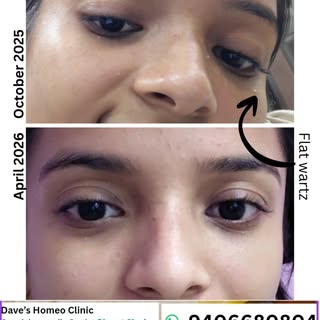 4 Months • Gentle Healing • Lasting Results ✨
Flat warts on the face can affect confidence, but true