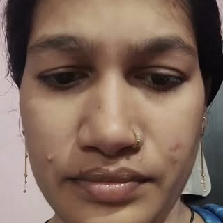 #acne #homeopathyheals #clearface