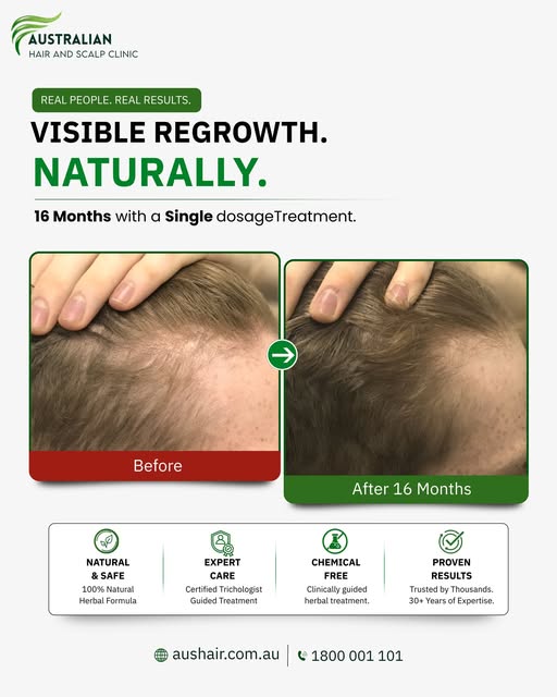 Thinning hair? Don’t just cover it, grow it back naturally.

One treatment. Real people. Visible reg