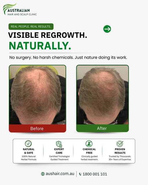 Hair regrowth takes time, but real progress can be visible.

This before and after shows what can ha