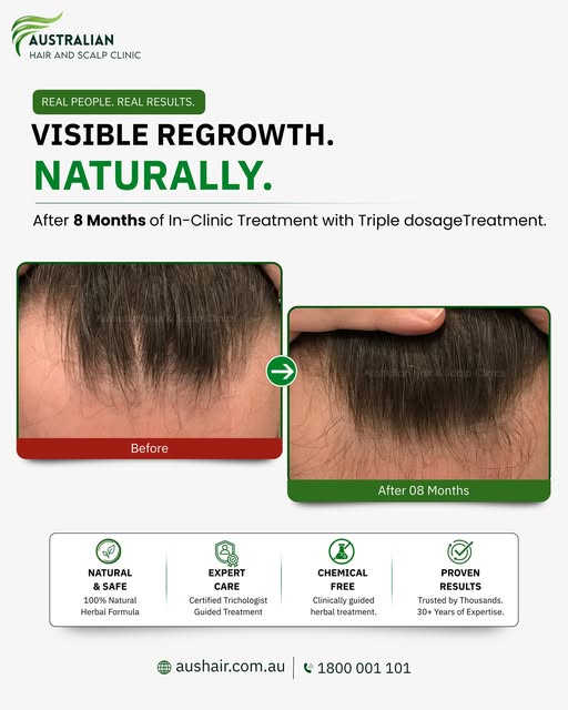 8 months later, the difference is hard to miss.

This patient achieved visible improvement in hair d