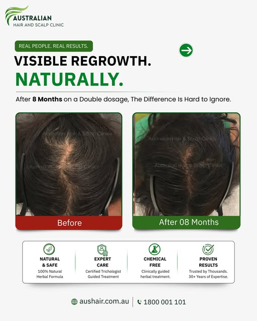 After 8 months, this beforeand after shows a visible improvement in hair coverage and scalp appearan