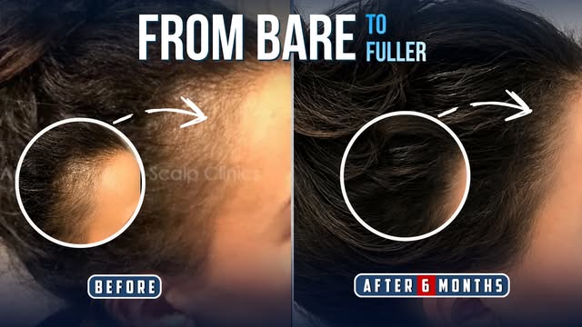 6 months. A visible change. And a very special day ahead.

She came to Australian Hair & Scalp Clini