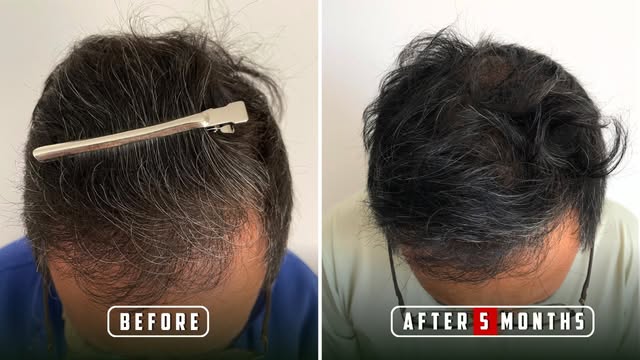 Grey hair getting you down? Here’s what changed in just 5 months.

A visible 5 month transformation 