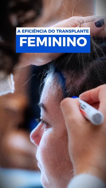 Transplante capilar em mulheres ✨ 

A paciente de hoje se incomoda com seu cabelo desde os 18 anos. 