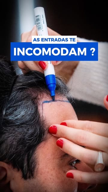 O quanto as entradas te incomodam?

O paciente do dia tinha exatamente essa queixa: o tamanho das en