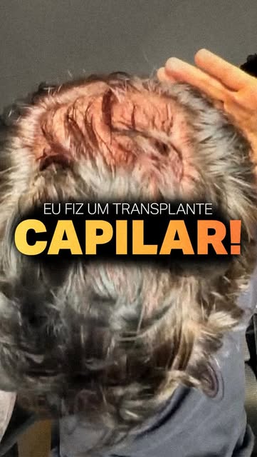 Nesse vídeo eu compartilho com vocês toda a minha evolução nesses primeiros 30 dias após o transplan