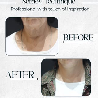 The Serdev Lift Technique is a minimally invasive procedure that lifts and repositions facial soft t