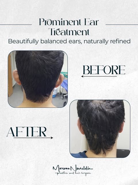 Prominent ears can affect facial balance and self-confidence at any age.
Prominent Ear Correction (O