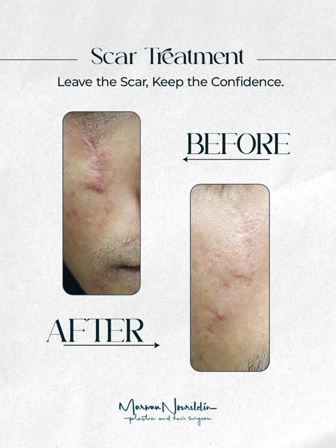 Scars may fade over time, but they don’t always disappear on their own.
With advanced scar treatment