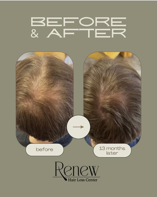13 months in… and we’re still working. 🔥

This before & after is a powerful reminder that hair rest