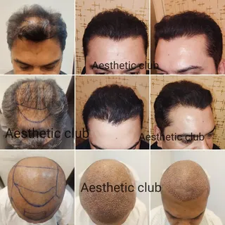 In hair transplanation, adding hairs in the preexisting hairs is a difficult task as there is a risk