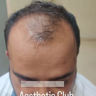 Hair Transplant result depends on multuple factors. Two most important aspects are hair line and den