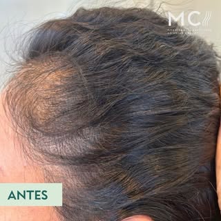 Antes y después | Alopecia difusa ✨

La alopecia difusa no se trata únicamente de la caída del cabel