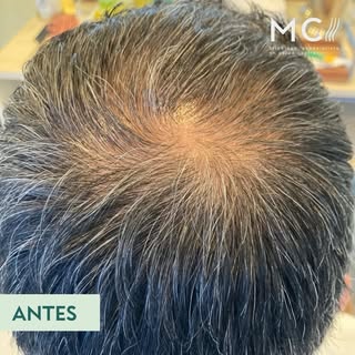 Resultado de tratamiento Tricoterapéutico. 

Objetivos del tratamiento:

1.- Prevenir la alopecia, n