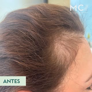 Resultado de tratamiento Tricoterapéutico. 

Objetivos del tratamiento:

1.- Prevenir la alopecia, n