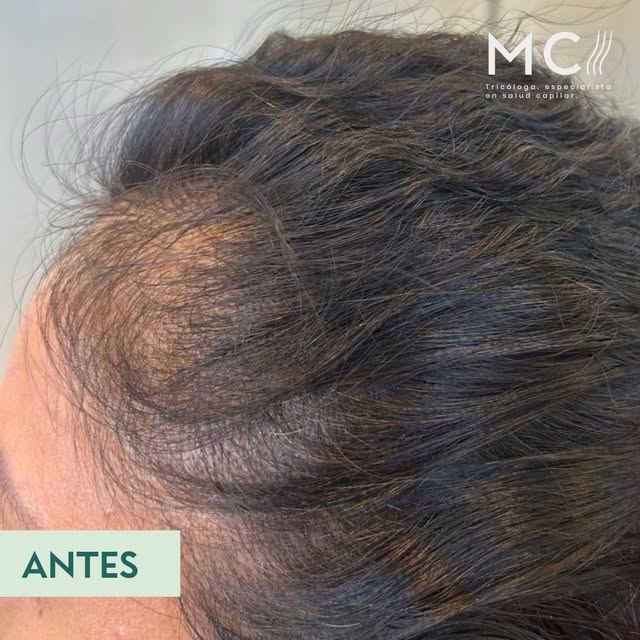 Resultado de tratamiento Tricoterapéutico. 

Objetivos del tratamiento:

1.- Prevenir la alopecia, n