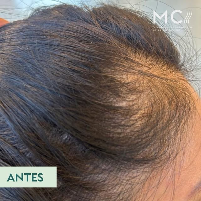Antes y después | Alopecia difusa ✨

La alopecia difusa no se trata únicamente de la caída del cabel